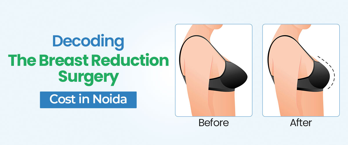 Decoding the Breast Reduction Surgery Cost in Noida