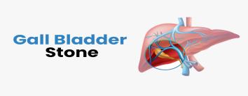 Gallbladder Stones Gallstones