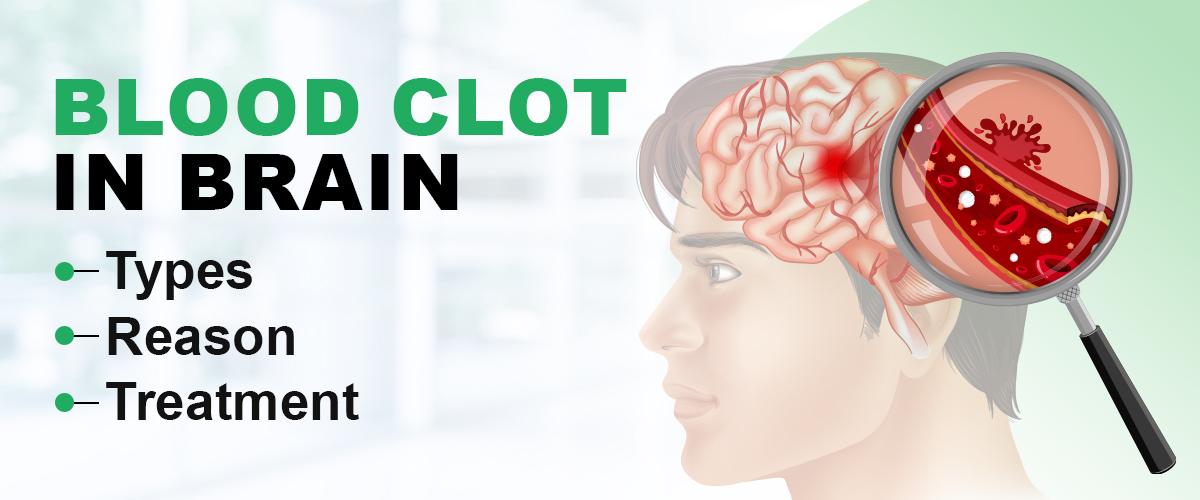 Blood Clot in Brain: Symptoms, Types, Reason & Treatment