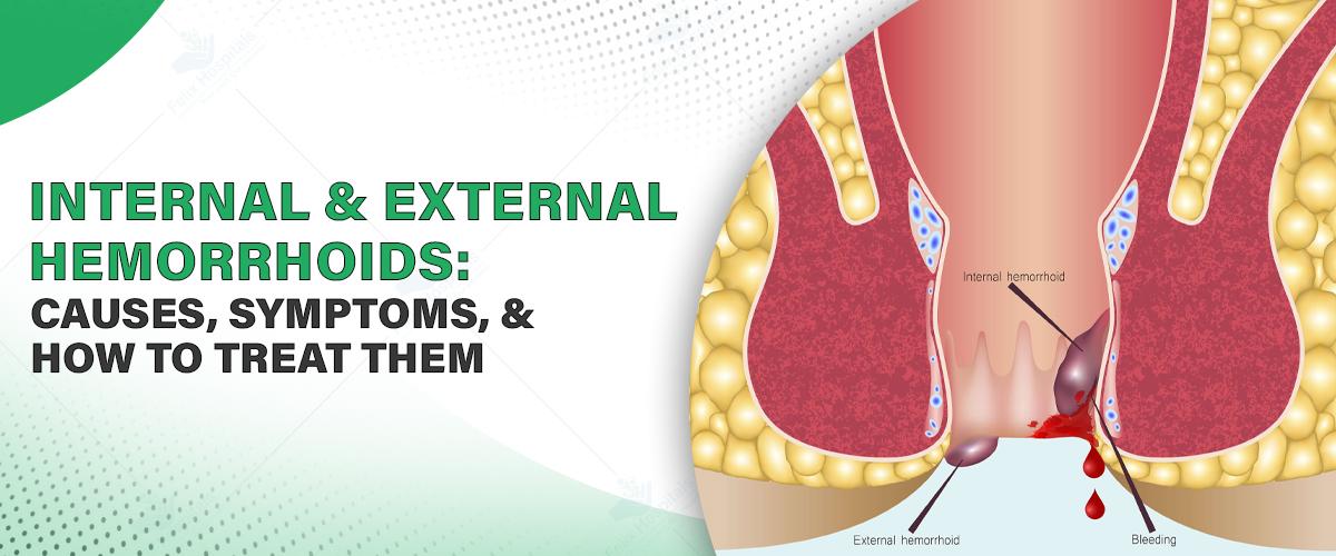 Internal and External Hemorrhoids: Causes, Symptoms, and How to Treat Them