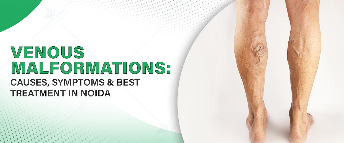 Venous Malformations: Causes, Symptoms & Best Treatment in Noida