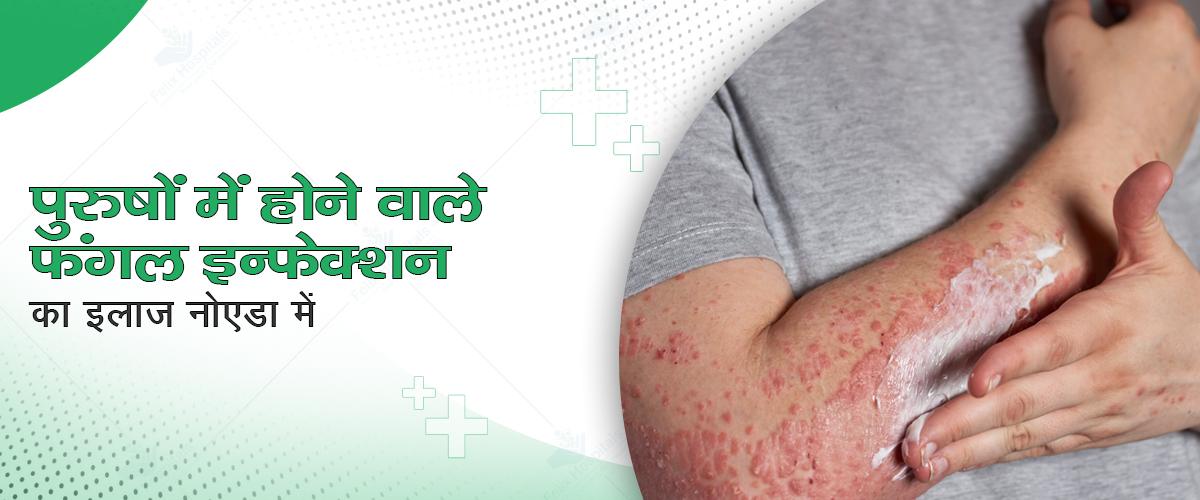 पुरुषों में फंगल इन्फेक्शन (Fungal Infection) : सावधानियां और इलाज