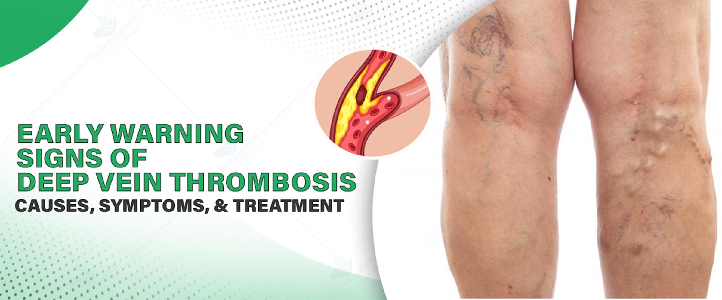 Early Warning Signs of Deep Vein Thrombosis You Shouldn’t Ignore