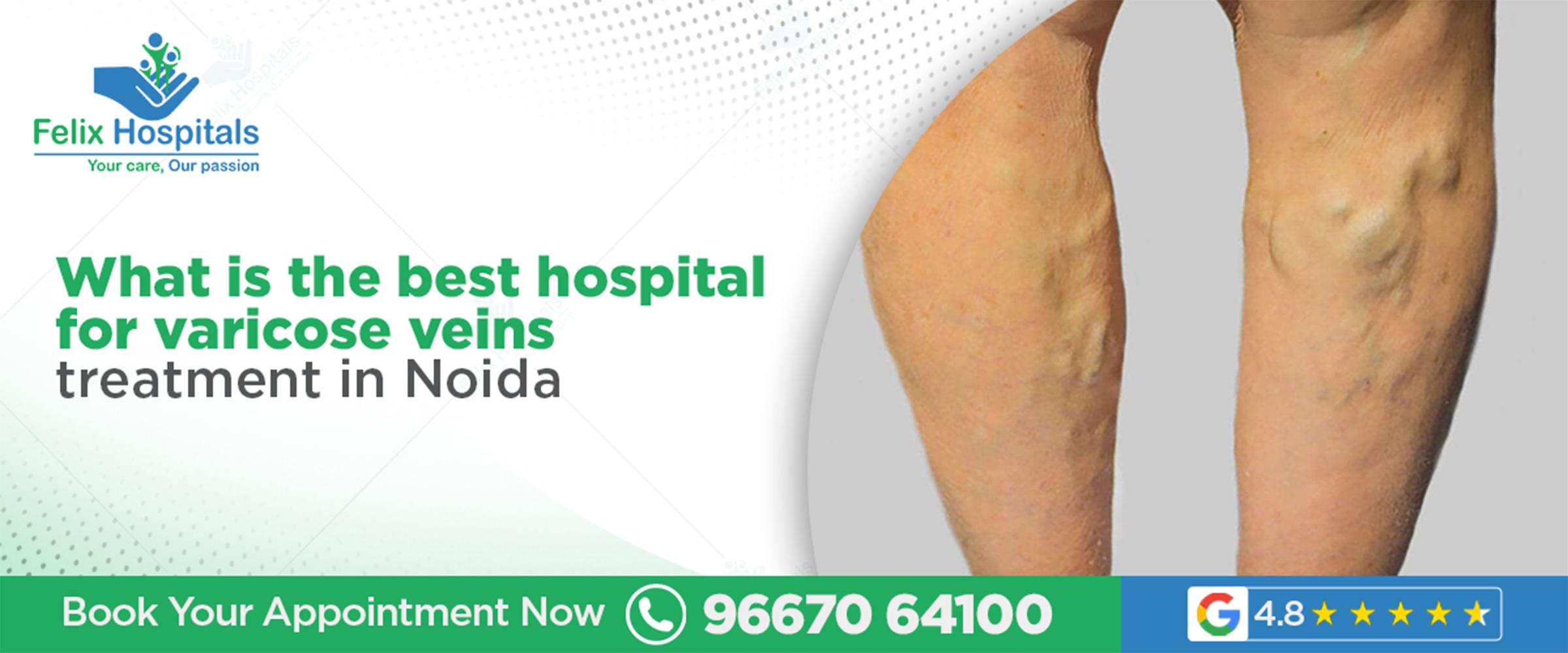 What is the best hospital for varicose veins treatment in Noida?