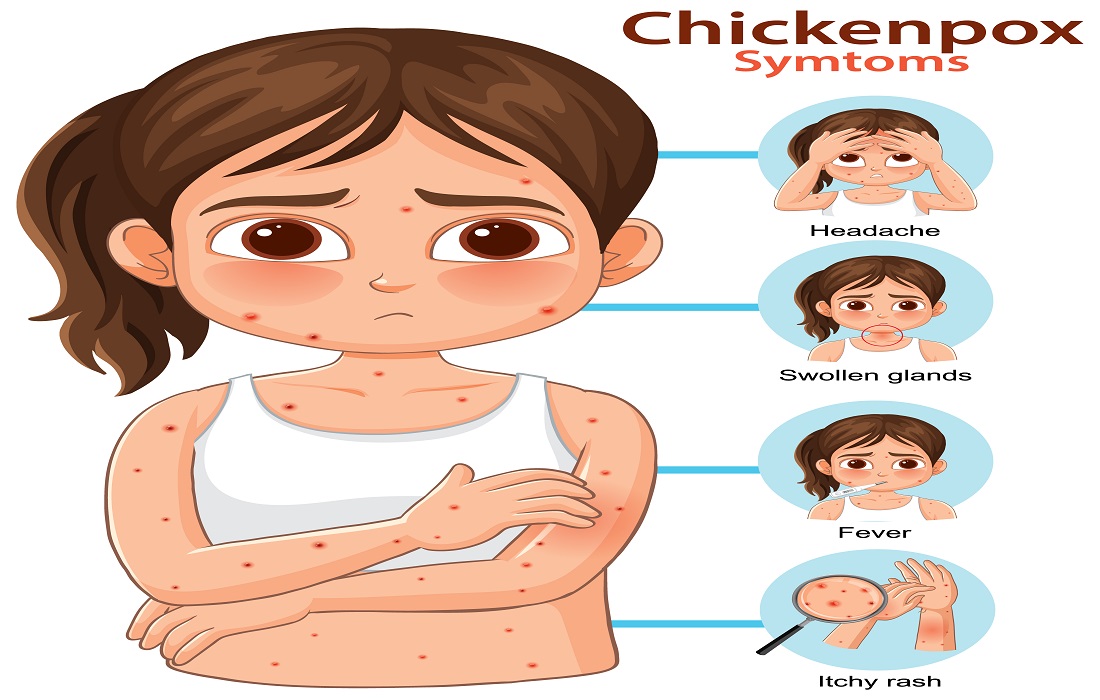 chickenpox-in-hindi