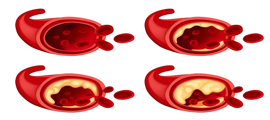 eep Vein Thrombosis