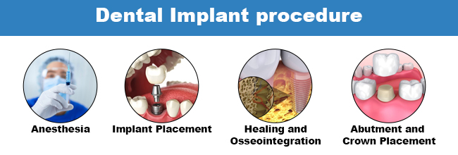 Dental Implant procedure