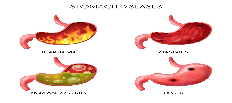 Gastric 