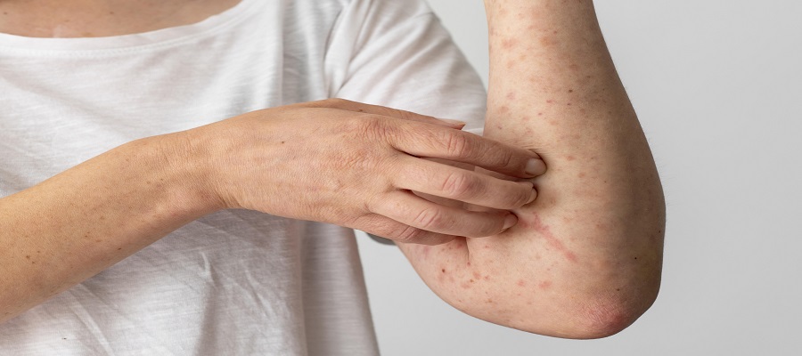 Lupus 