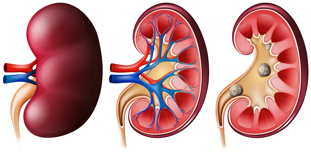 Types of Kidney Failure