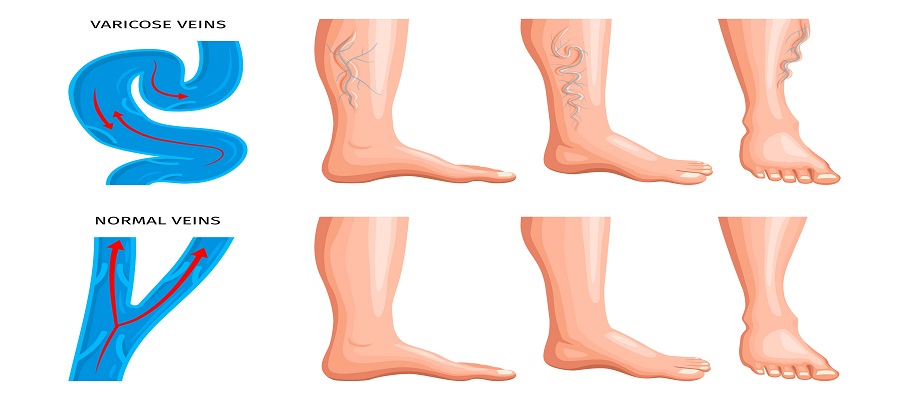 Varicose Veins during Pregnancy