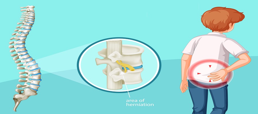 What is Disc Replacement Surgery? Causes, Procedure, and Recovery