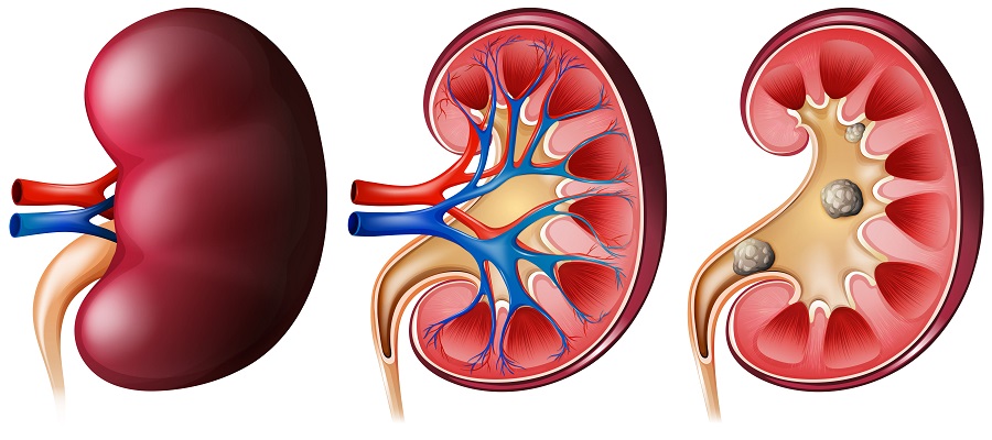 Preparation Prior to Kidney Surgery medicals