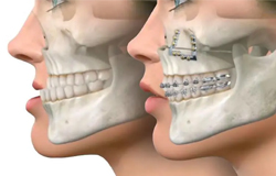 Orthognathic Surgery