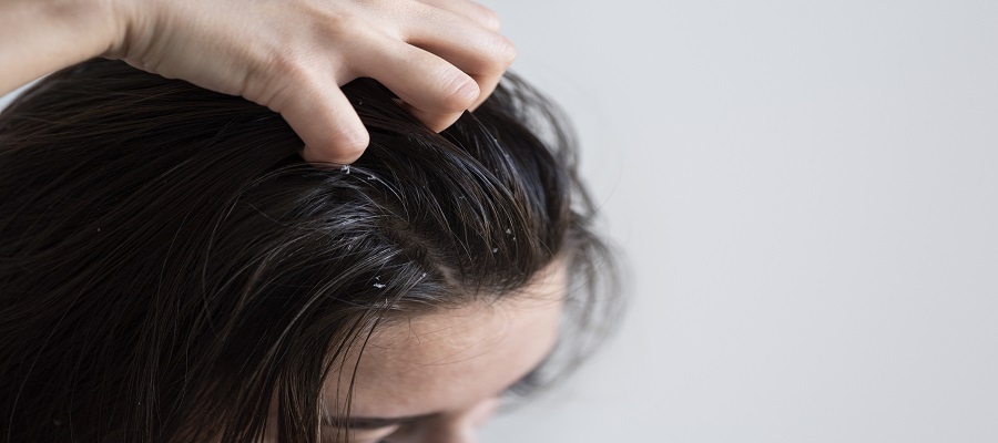 Scalp Seborrheic Dermatitis