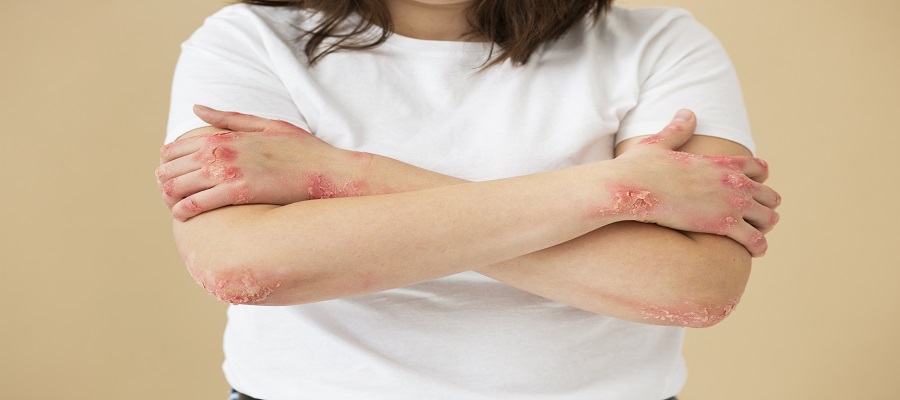 Seborrheic Dermatitis