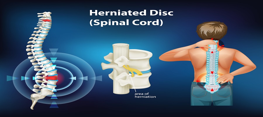 Herniated or Bulging Disc