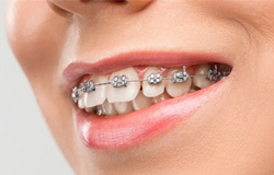 Traditional braces