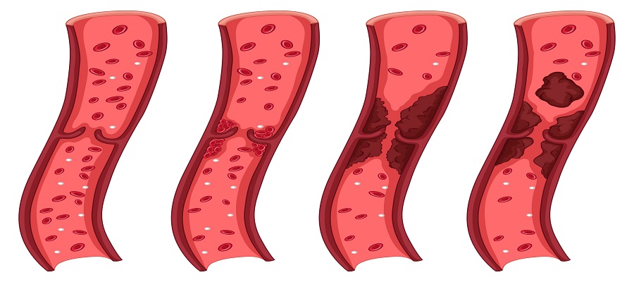 Deep Vein Thrombosis