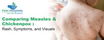 Comparing Measles and Chickenpox