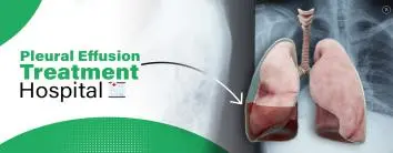Best pneumonia treatment Hospital in Noida