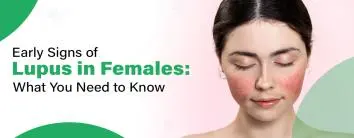 Early Signs of Lupus in Females