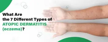 Best Hospital for Eczema (Atopic Dermatitis) Treatment