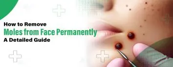 Best Hospital for Moles Removal in Noida