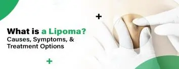 Lipoma