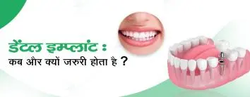 dental implant