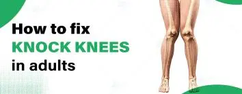Knock Knees in Adulthood