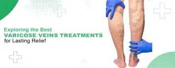  Best Varicose Vein Treatments for Lasting Relief