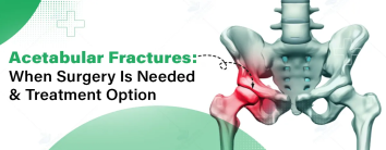 Acetabular Fractures