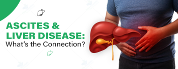 Ascites and Liver Disease: What’s the Connection?