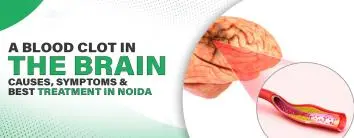 Blood Clot in the Brain