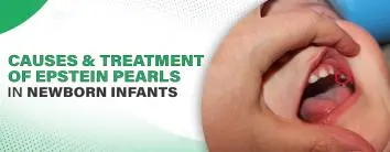 Causes and Treatment of Epstein Pearls in Newborn Babies