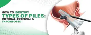 How to Identify Types of Piles: Internal, External, and Thrombosed