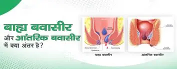 बाह्य बवासीर और आंतरिक बवासीर में क्या अंतर है? 