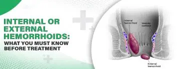 Internal or External Hemorrhoids: What You Need to Know Before Treatment