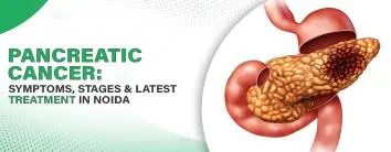 Pancreatic Cancer: Symptoms, Stages & Latest Treatment in Noida
