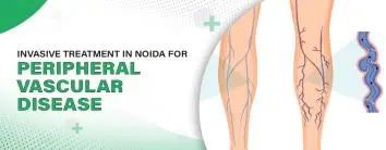 Invasive treatment in Noida for Peripheral Vascular disease