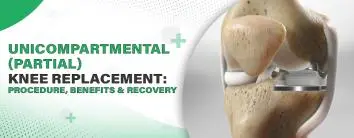 Unicompartmental (Partial) Knee Replacement: Procedure, Benefits & Recovery
