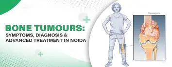 Bone Tumours: Symptoms, Diagnosis & Advanced Treatment in Noida