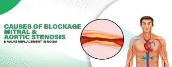Causes of Blockage (Mitral & Aortic Stenosis) & Valve Replacement in Noida