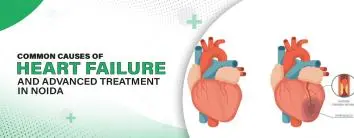 Common Causes of Heart Failure and Advanced Treatment in Noida