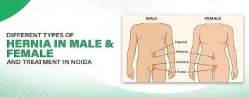 Different types of hernia in male and female and treatment in noida