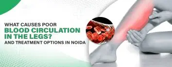Causes of Poor Blood Circulation in Legs & Treatment Options in Noida