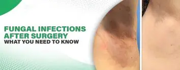 Fungal Infections After Surgery
