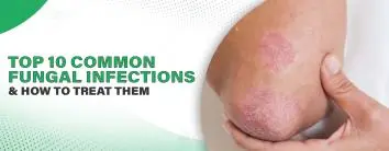 Top 10 Common Fungal Infections and How to Treat Them