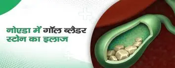 नोएडा में गॉल ब्लैडर स्टोन का इलाज | Noida mein Gall Bladder Stone ka Ilaj in hindi
